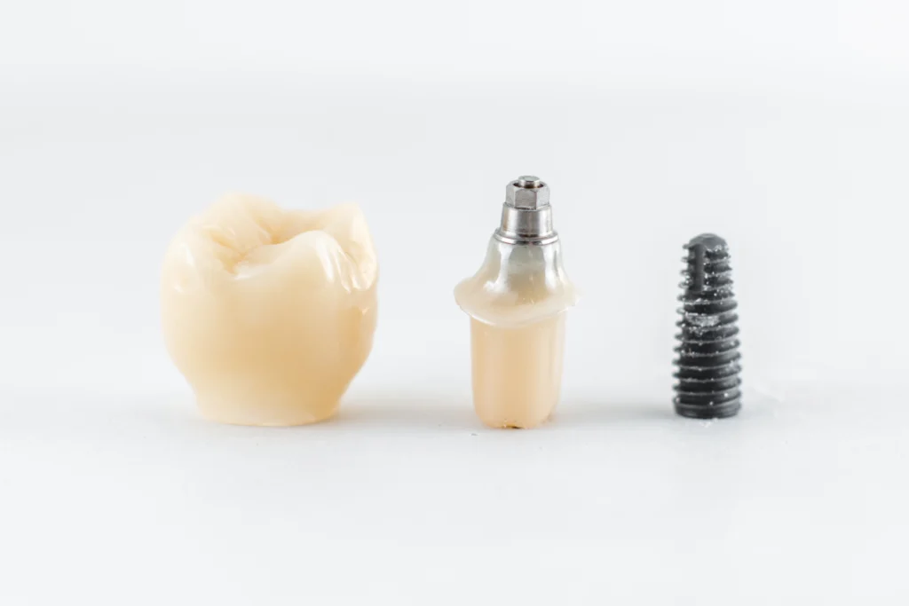 couronne implant dentaire couronne implant dentaire Implants dentaires Laboratoire Émail Santé
