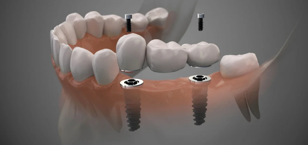 implant dentaire bridge Nos solutions Laboratoire Émail Santé