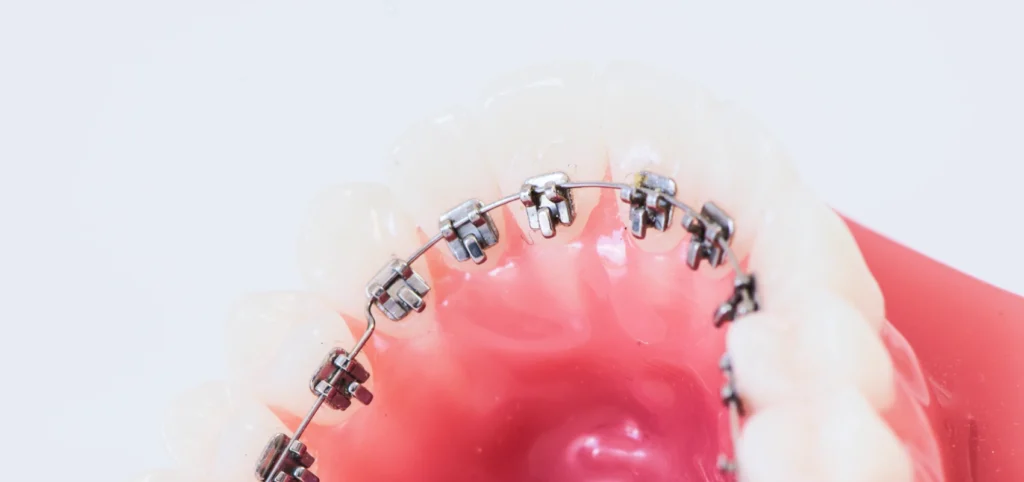 orthodontie linguale