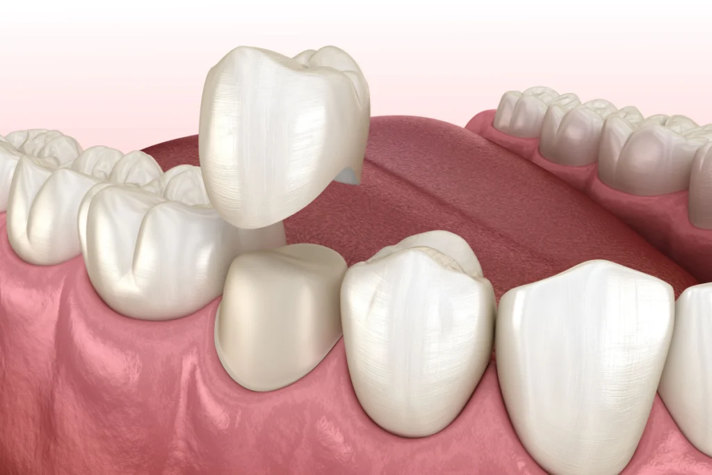 couronnes dentaires couronnes dentaires Prothèses fixes Laboratoire Émail Santé