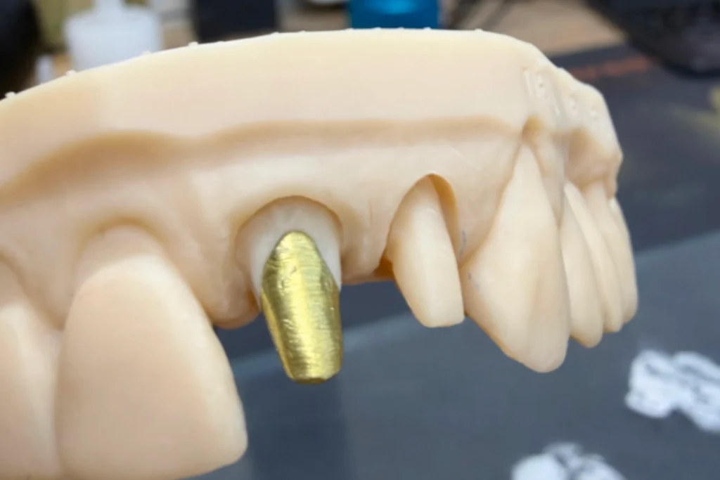 inlays onlays cores titane anodise inlays onlays cores titane anodise Prothèses fixes Laboratoire Émail Santé