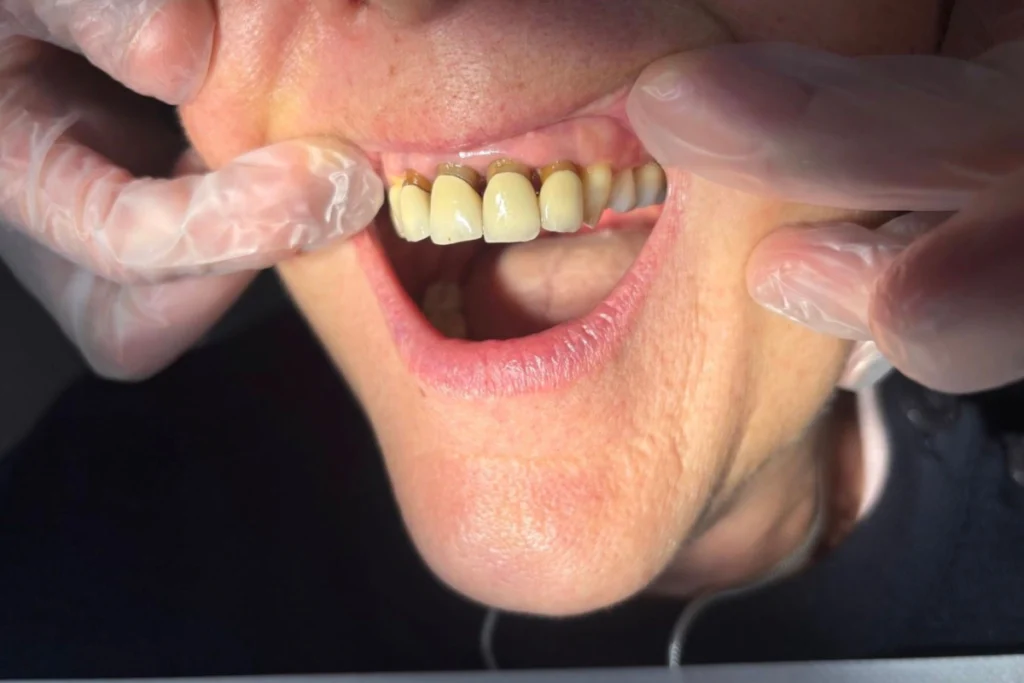 laboratoire dentaire email sante nantes laboratoire dentaire email sante nantes Prothèses fixes Laboratoire Émail Santé