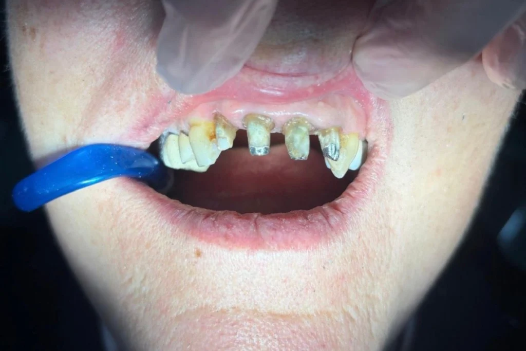 laboratoire dentaire email sante nantes laboratoire dentaire email sante nantes Prothèses fixes Laboratoire Émail Santé