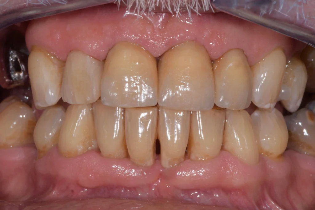 laboratoire dentaire email sante nantes laboratoire dentaire email sante nantes Prothèses fixes Laboratoire Émail Santé