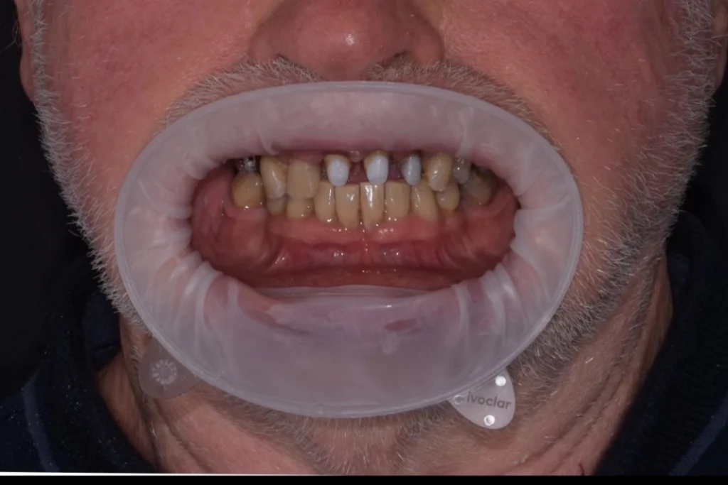 laboratoire dentaire email sante nantes laboratoire dentaire email sante nantes Prothèses fixes Laboratoire Émail Santé