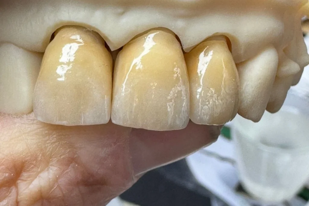 laboratoire dentaire email sante nantes laboratoire dentaire email sante nantes Prothèses fixes Laboratoire Émail Santé